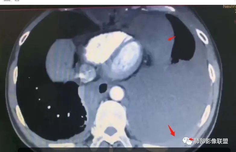 影像PPT - 【病例】胸膜弥漫性连续性增厚—恶性间皮瘤-39 影像PPT - 【病例】胸膜弥漫性连续性增厚—恶性间皮瘤-39
