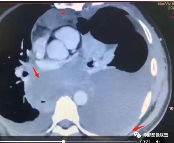 影像PPT - 【病例】胸膜弥漫性连续性增厚—恶性间皮瘤-40 影像PPT - 【病例】胸膜弥漫性连续性增厚—恶性间皮瘤-40