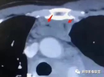 影像PPT - 【病例】胸膜弥漫性连续性增厚—恶性间皮瘤-42 影像PPT - 【病例】胸膜弥漫性连续性增厚—恶性间皮瘤-42