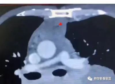 影像PPT - 【病例】胸膜弥漫性连续性增厚—恶性间皮瘤-43 影像PPT - 【病例】胸膜弥漫性连续性增厚—恶性间皮瘤-43