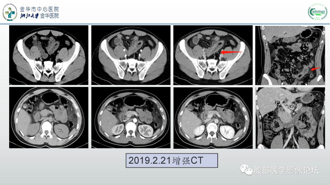 影像PPT - 【病例】嗜酸细胞增多综合征1例CT影像表现-5