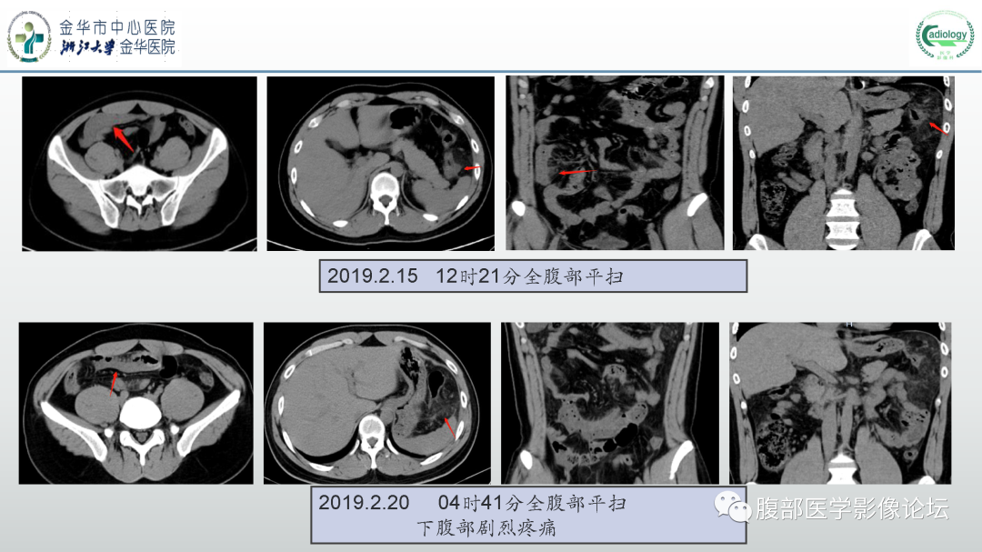 影像PPT - 【病例】嗜酸细胞增多综合征1例CT影像表现-4