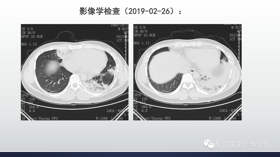 影像PPT - 【病例】嗜酸细胞增多综合征1例CT影像表现-6