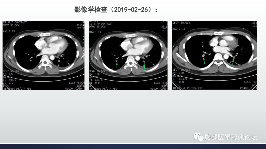 影像PPT - 【病例】嗜酸细胞增多综合征1例CT影像表现-7