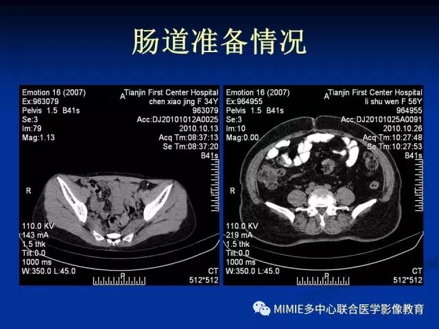 影像PPT - 【PPT】女性生殖系统正常解剖及表现-7