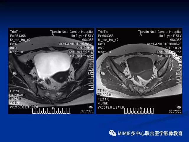 影像PPT - 【PPT】女性生殖系统正常解剖及表现-9