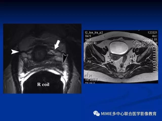 影像PPT - 【PPT】女性生殖系统正常解剖及表现-11
