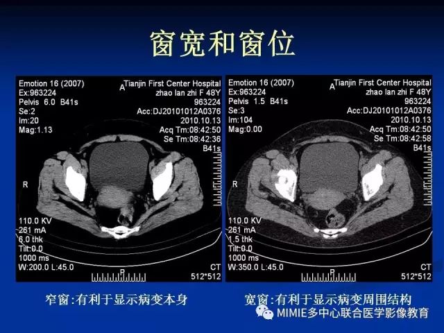影像PPT - 【PPT】女性生殖系统正常解剖及表现-6