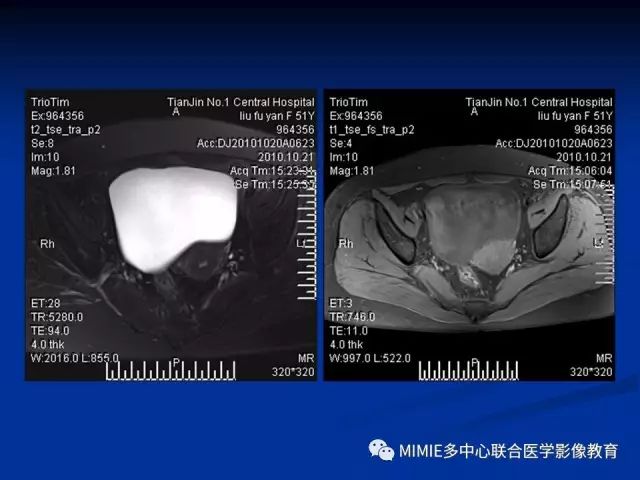 影像PPT - 【PPT】女性生殖系统正常解剖及表现-13