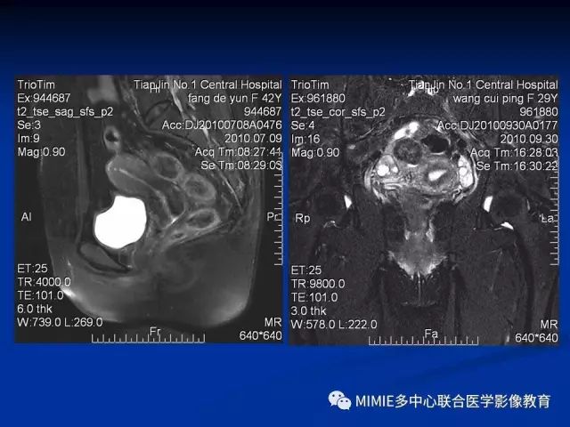 影像PPT - 【PPT】女性生殖系统正常解剖及表现-15