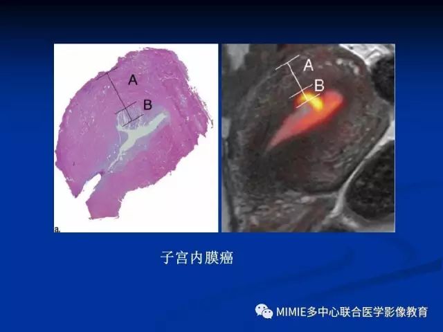 影像PPT - 【PPT】女性生殖系统正常解剖及表现-17