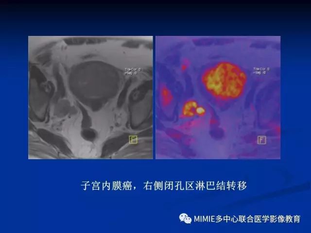 影像PPT - 【PPT】女性生殖系统正常解剖及表现-18