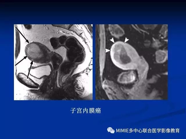 影像PPT - 【PPT】女性生殖系统正常解剖及表现-20