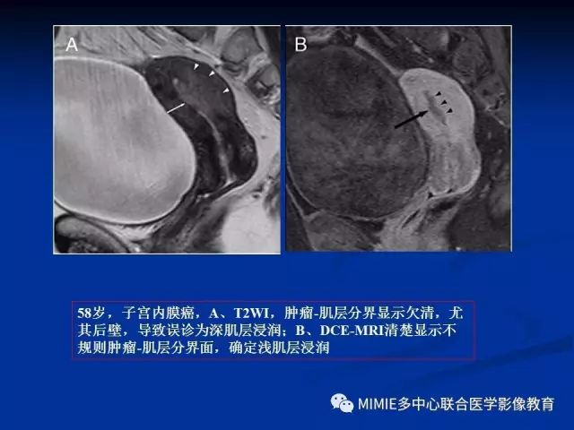 影像PPT - 【PPT】女性生殖系统正常解剖及表现-21