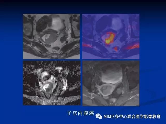 影像PPT - 【PPT】女性生殖系统正常解剖及表现-22