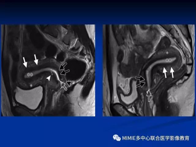 影像PPT - 【PPT】女性生殖系统正常解剖及表现-30