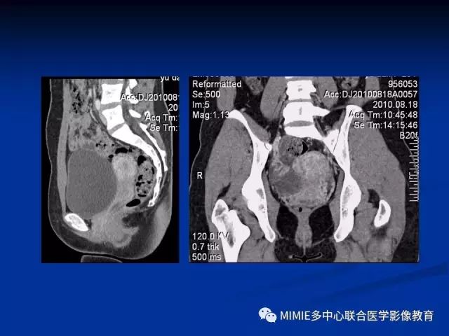 影像PPT - 【PPT】女性生殖系统正常解剖及表现-33