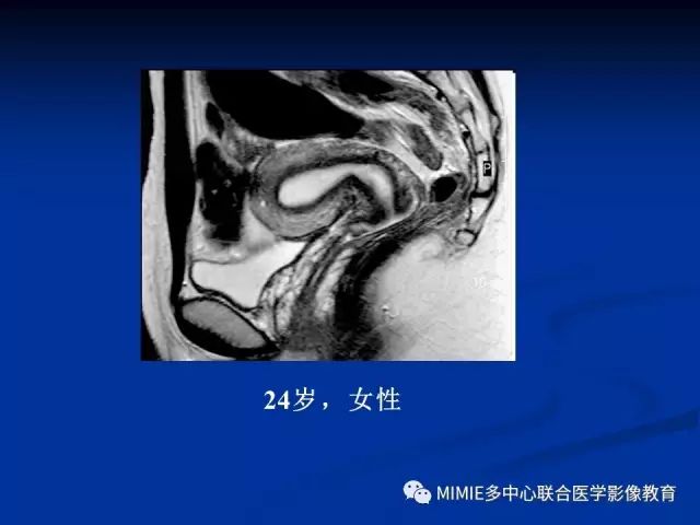 影像PPT - 【PPT】女性生殖系统正常解剖及表现-36