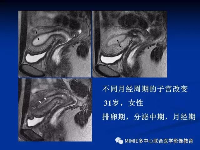影像PPT - 【PPT】女性生殖系统正常解剖及表现-42
