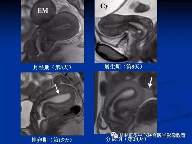 影像PPT - 【PPT】女性生殖系统正常解剖及表现-43