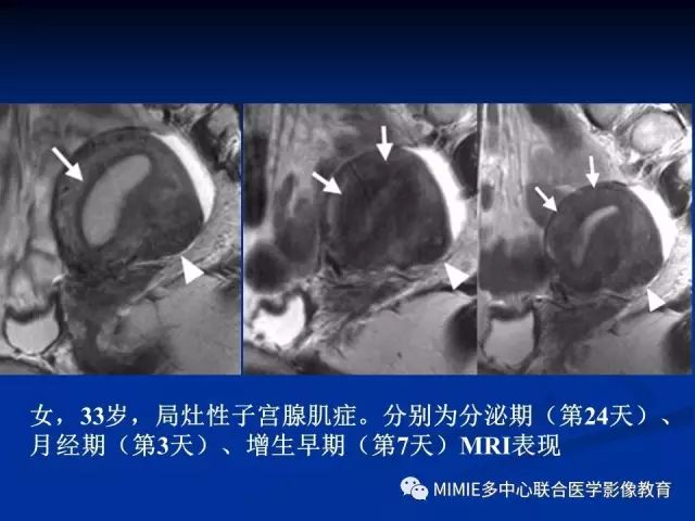 影像PPT - 【PPT】女性生殖系统正常解剖及表现-44