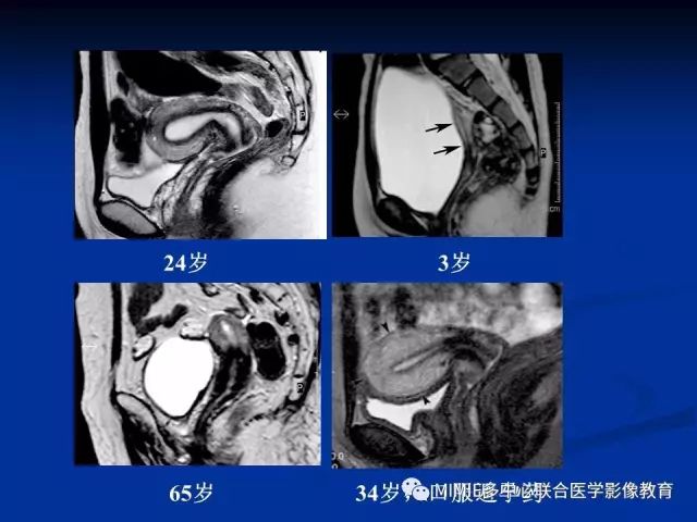 影像PPT - 【PPT】女性生殖系统正常解剖及表现-45