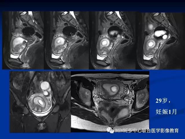 影像PPT - 【PPT】女性生殖系统正常解剖及表现-46