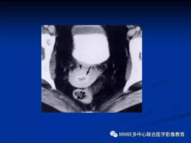 影像PPT - 【PPT】女性生殖系统正常解剖及表现-48