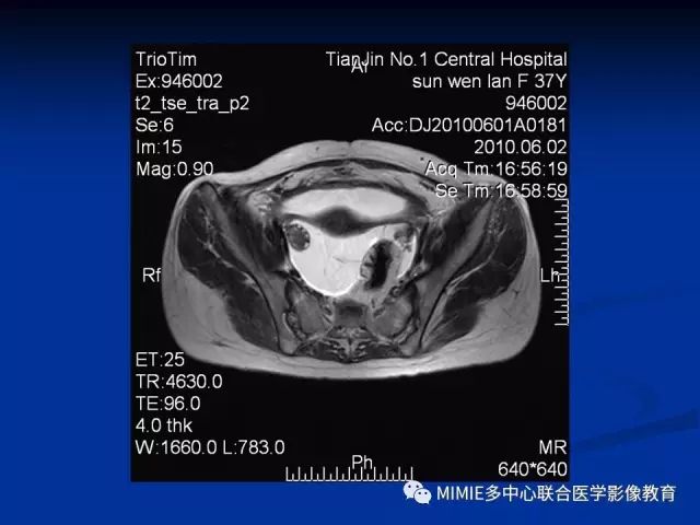 影像PPT - 【PPT】女性生殖系统正常解剖及表现-50