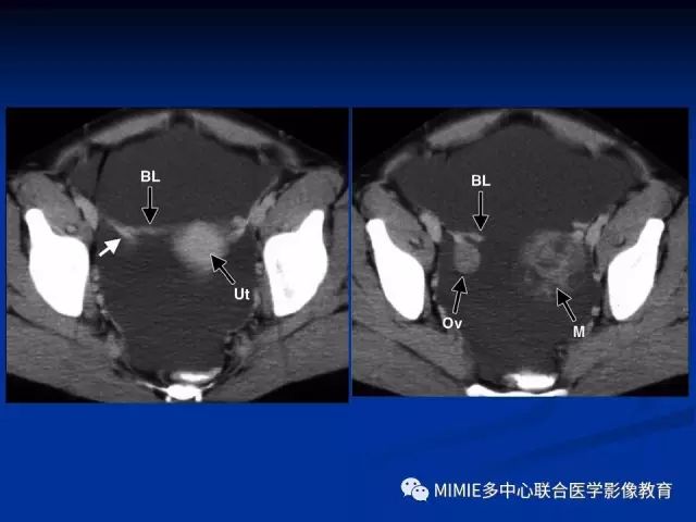 影像PPT - 【PPT】女性生殖系统正常解剖及表现-51