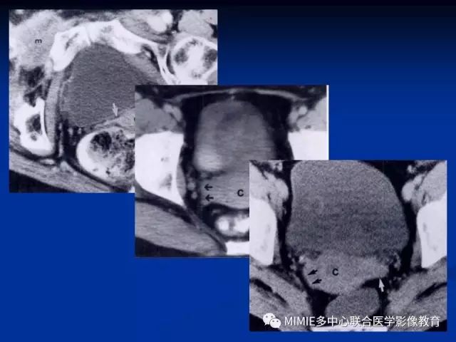 影像PPT - 【PPT】女性生殖系统正常解剖及表现-55