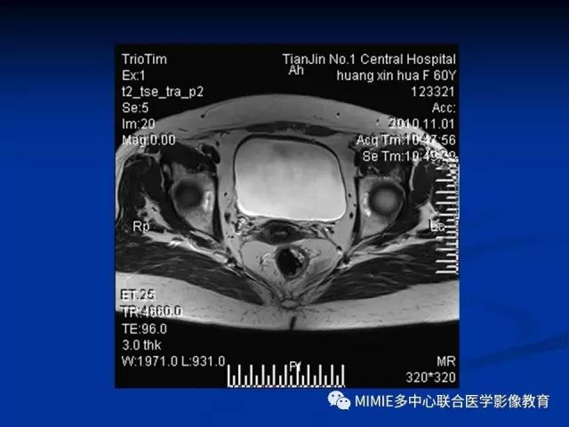 影像PPT - 【PPT】女性生殖系统正常解剖及表现-56