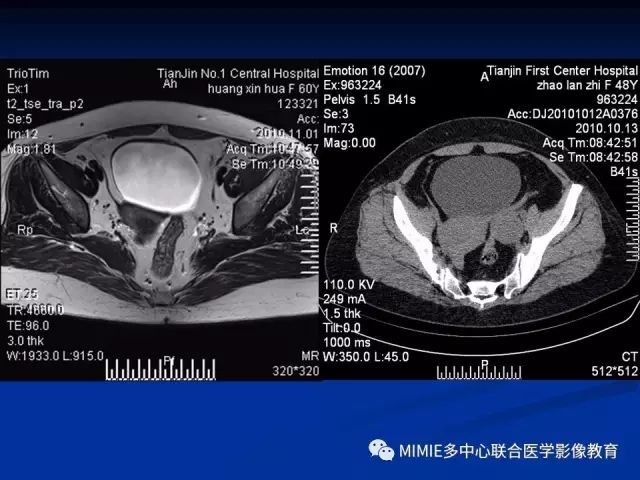影像PPT - 【PPT】女性生殖系统正常解剖及表现-53