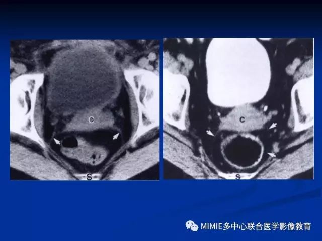 影像PPT - 【PPT】女性生殖系统正常解剖及表现-58