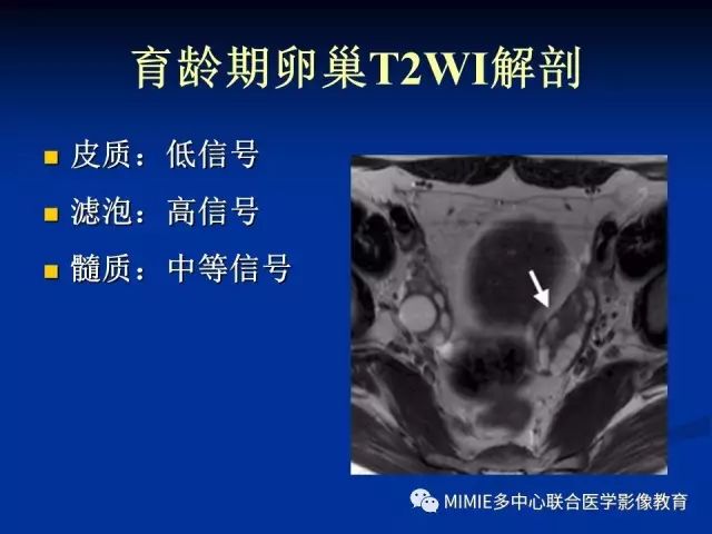 影像PPT - 【PPT】女性生殖系统正常解剖及表现-60