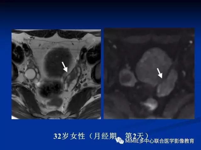 影像PPT - 【PPT】女性生殖系统正常解剖及表现-62