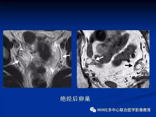 影像PPT - 【PPT】女性生殖系统正常解剖及表现-66