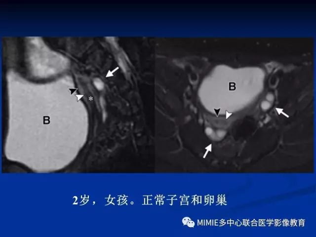 影像PPT - 【PPT】女性生殖系统正常解剖及表现-65
