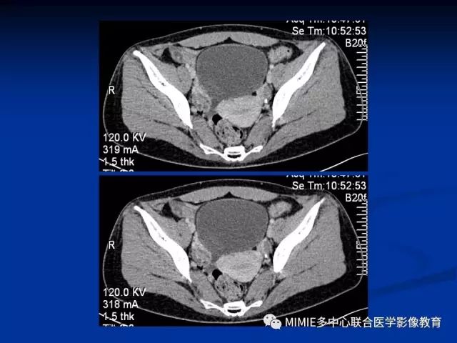 影像PPT - 【PPT】女性生殖系统正常解剖及表现-67