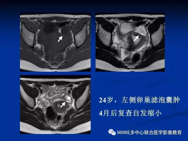 影像PPT - 【PPT】女性生殖系统正常解剖及表现-70