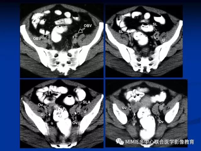 影像PPT - 【PPT】女性生殖系统正常解剖及表现-72