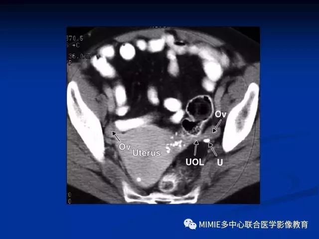 影像PPT - 【PPT】女性生殖系统正常解剖及表现-75