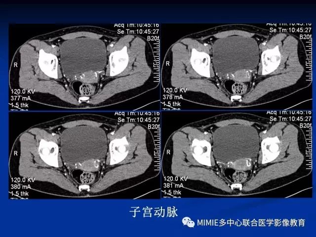 影像PPT - 【PPT】女性生殖系统正常解剖及表现-78