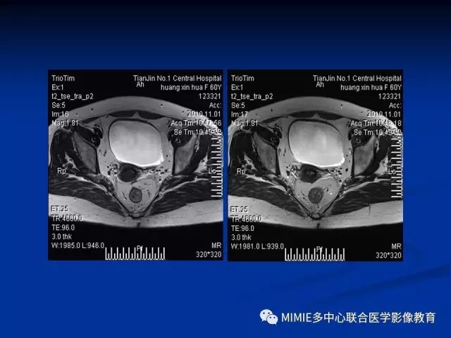 影像PPT - 【PPT】女性生殖系统正常解剖及表现-79