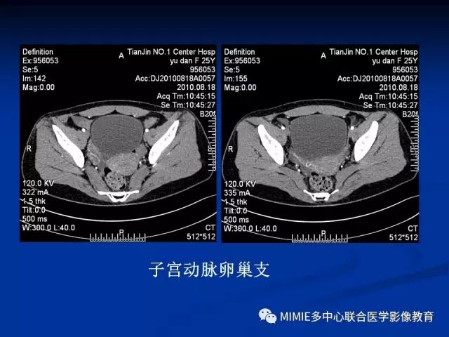 影像PPT - 【PPT】女性生殖系统正常解剖及表现-82