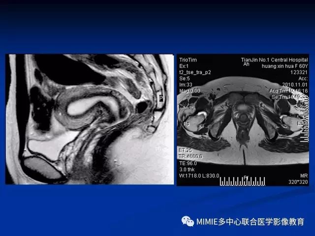 影像PPT - 【PPT】女性生殖系统正常解剖及表现-88