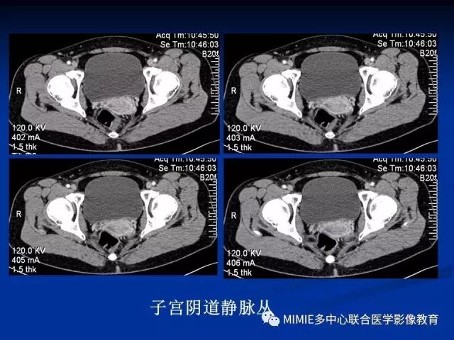 影像PPT - 【PPT】女性生殖系统正常解剖及表现-85