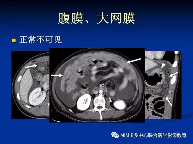 影像PPT - 【PPT】女性生殖系统正常解剖及表现-91