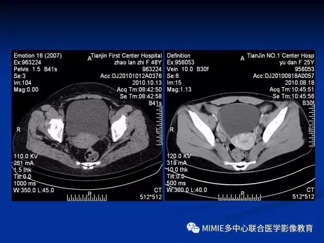 影像PPT - 【PPT】女性生殖系统正常解剖及表现-2