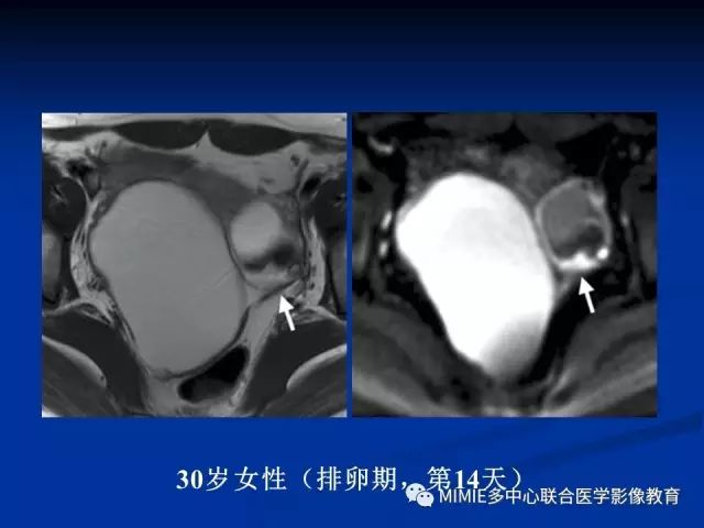 影像PPT - 【PPT】女性生殖系统正常解剖及表现-5